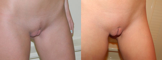 Vorher-Nachher Foto der Intimrasur einer Frau. Vorher Landing Strip, nachher komplett rasierter Schambereich.