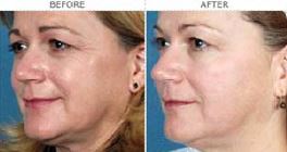 Ipl Haarentfernung Vorher Nachher : Haarentfernungen - Laser Gesicht ...